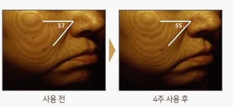 뺨 피부를 등고선으로 촬영한 사진 두 장. 사용 전 각도 표시 57, 4주 사용 후 각도 표시 55