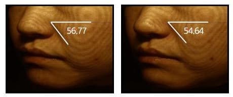 뺨 피부를 등고선으로 촬영한 사진 두 장. 제품 사용 전 각도 표시 56.77, 제품 4주 사용 후 각도 표시 54.64