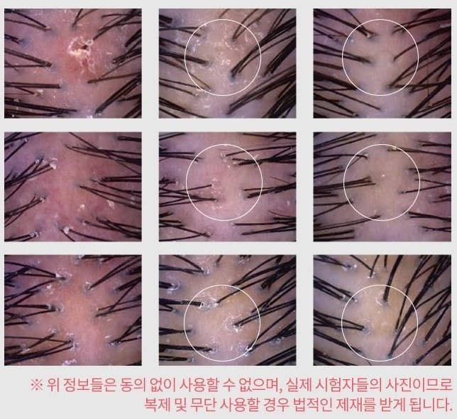 두피(붉은기) 진정 효과 시험 9컷 — 피험자들의 [사용 전], [사용 2주 후], [사용 4주 후] 두피 붉은기 변화 측정 사진