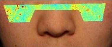 사용 전 — 코 아래 얼굴 사진, 좌우 볼에 겉 멜라닌 색 지도(빨강 · 노랑 · 초록)