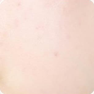 사용 전 — 뺨 피부를 가까이 찍은 사진. 붉은 잡티가 보인다